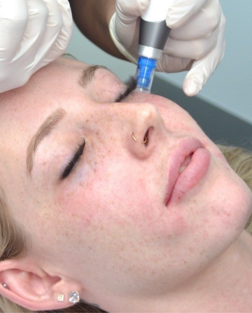 Skin microneedling Collagen induction National Skin Cancer Centres
